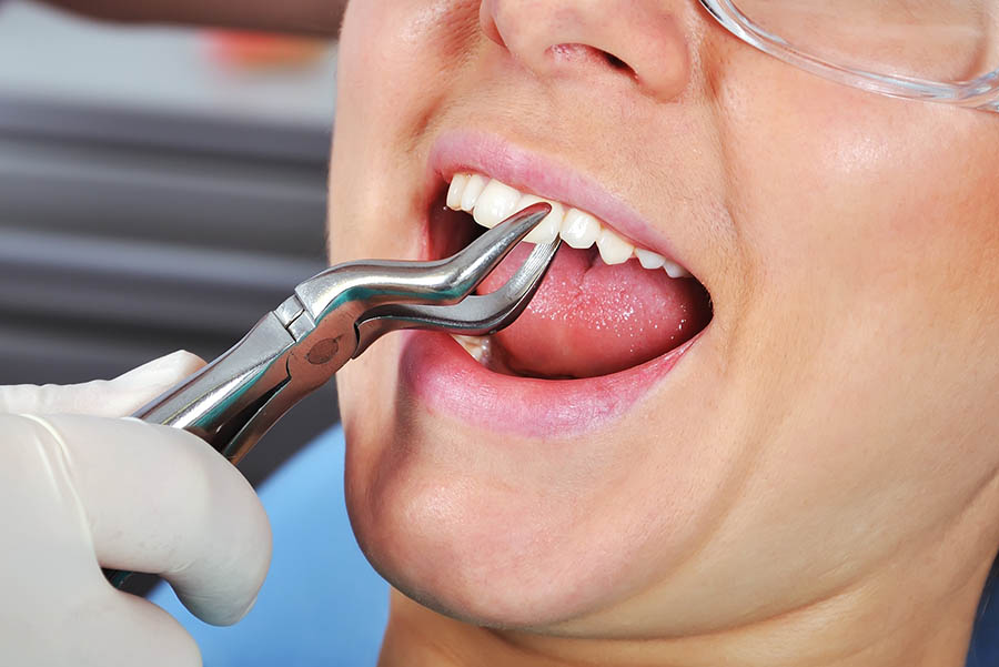 Extractions Home of Dentistry