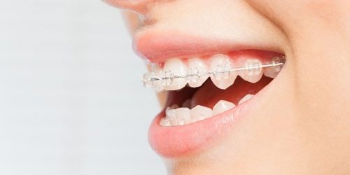 ceramic-braces-min