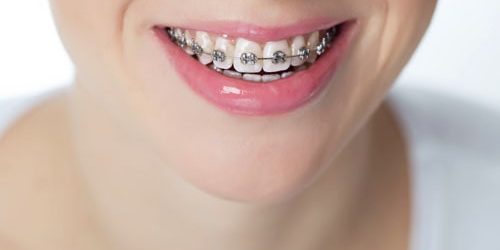 Braces for Adults, Braces in West Midlands